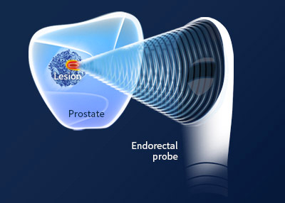 Traitement laser prostate