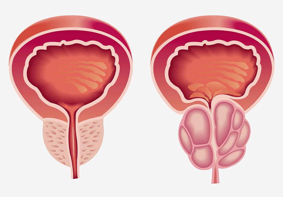 adenome prostate