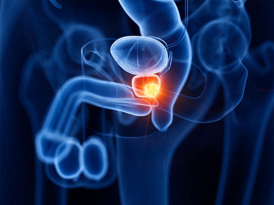 Cancer de la prostate