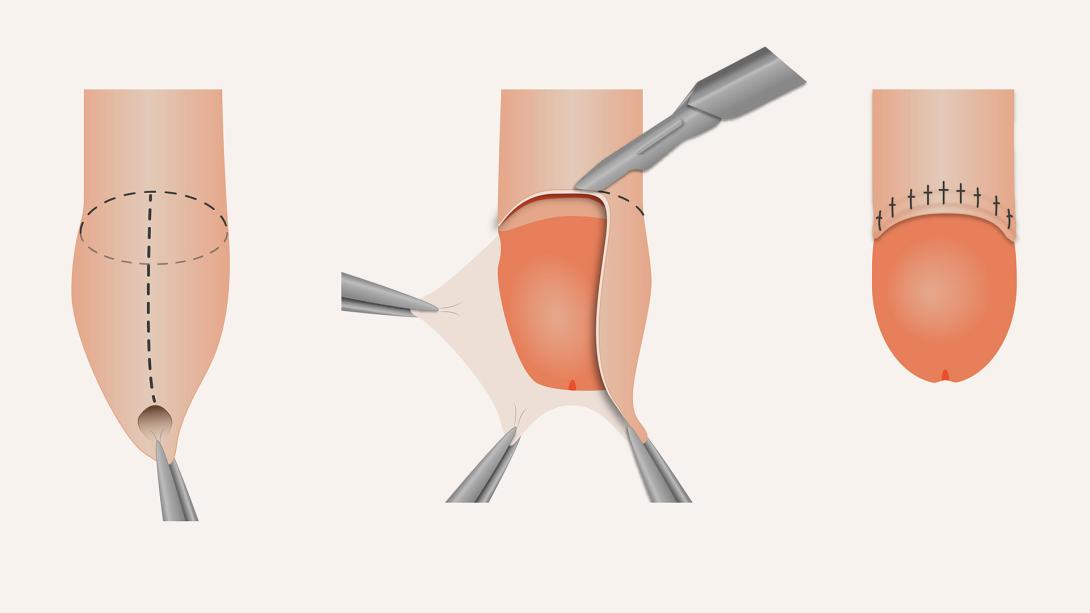 circoncision